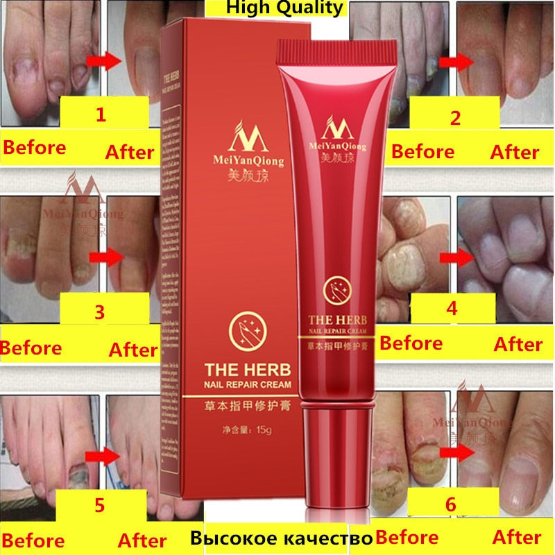 Herbal Nail Treatment Onychomycosis Paronychia Anti Fungal Nail Infection Good Result Chinese Herbal Toe Nail Fungus Treatment